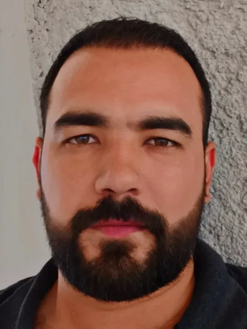 Saç ekimi sonrası, vaka 2